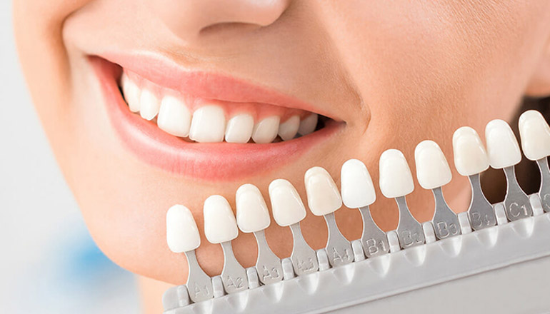 kitchener teeth whitening solutions